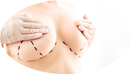 Mastopexia. Remodelación de la forma de las mamas