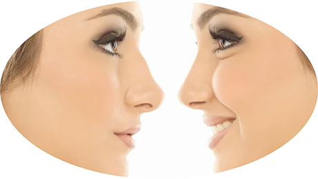 Cirugía para la Rinoplastia en Cuba. Remodelación de los defecto de la nariz Cirugía para la Rinoplastia en Cuba. Remodelación de los defecto de la nariz